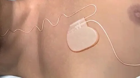 New sleep apnea device gets FDA approval